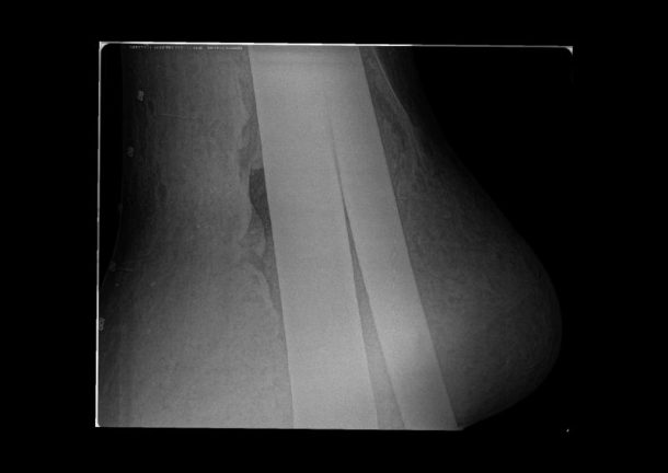 大卫的x射线图像的左脚显示金属电枢渗透进基地。图像©天祥集团无损检测。