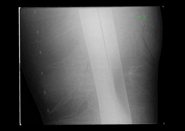 x光显示两个金属棒在大卫的左腿。